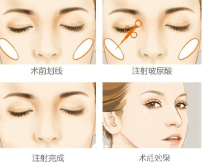 打玻尿酸貴不貴？選擇長春莎圖蕊注射玻尿酸3600元起就能做