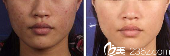 韓國(guó)S&U CLINIC整形醫(yī)院祛痘案例 韓國(guó)S&U CLINIC整形醫(yī)院祛痘案例