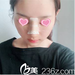 <!--<i data=20240703-sp></i>-->隆鼻案例術(shù)后4天效果