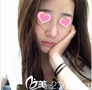 <!--<i data=20240703-sp></i>-->鼻綜合案例術(shù)后35天樣子