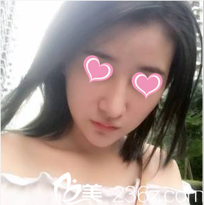 親身體驗韓國心美眼醫(yī)院隆鼻技術(shù)你來看我做鼻綜合第57天效果