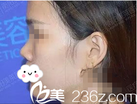 手術(shù)前側(cè)面照 手術(shù)前側(cè)面照