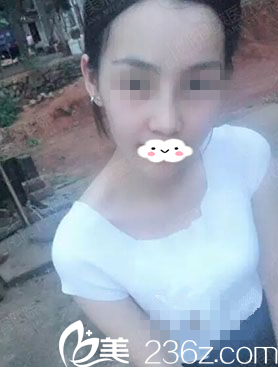 術(shù)后20天 術(shù)后20天