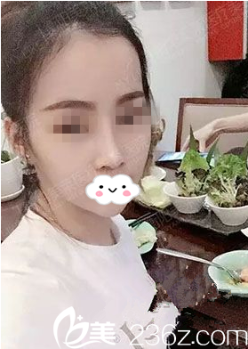 衡陽美萊芭比barbie混血美鼻整形怎么樣，真人術(shù)前術(shù)后對(duì)比照片分享