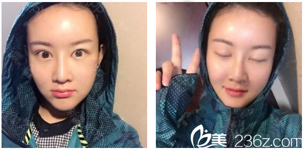 廣州華美整形醫(yī)院郝永生自體脂肪面部填充術(shù)后半個(gè)月吸收效果圖 廣州華美整形醫(yī)院郝永生自體脂肪面部填充術(shù)后半個(gè)月吸收效果圖