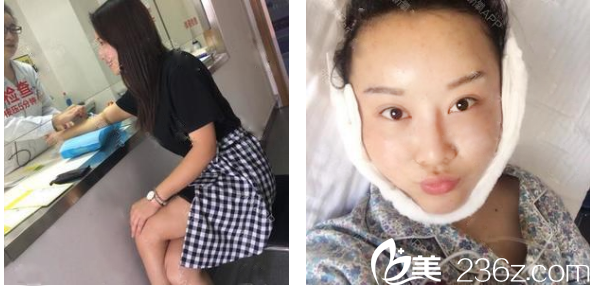 廣州華美郝永生自體脂肪全臉填充術(shù)后即刻效果圖 廣州華美郝永生自體脂肪全臉填充術(shù)后即刻效果圖