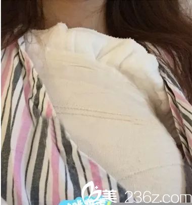 剛做完假體隆胸術(shù)后腫脹期 剛做完假體隆胸術(shù)后腫脹期