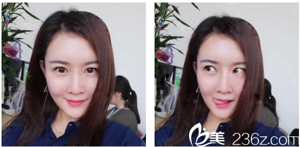 看了廣州華美郝永生和鄭志芳的案例后選擇郝永生做了自體脂肪填充面部和抽脂