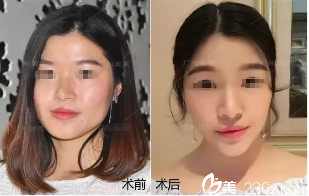 面部注射玻尿酸案例 面部注射玻尿酸案例