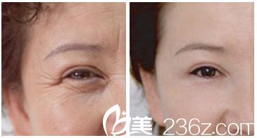 激光除皺術(shù)前術(shù)后對(duì)比案例 激光除皺術(shù)前術(shù)后對(duì)比案例