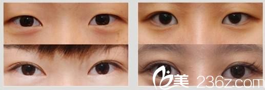 王紅敏醫(yī)生做雙眼皮案例 王紅敏醫(yī)生做雙眼皮案例