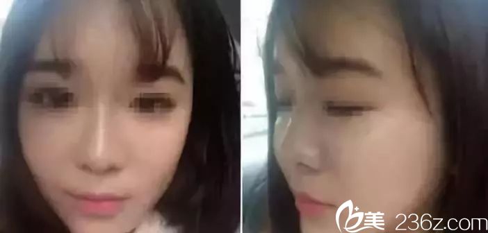 剛注射完玻尿酸除皺 剛注射完玻尿酸除皺