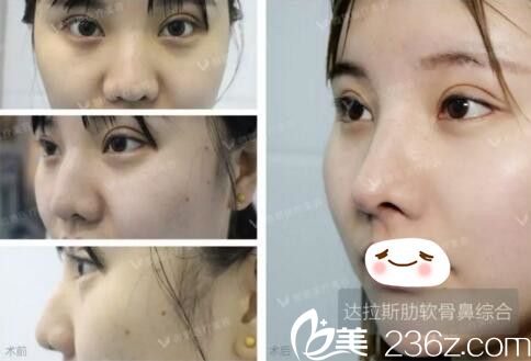 滕召勇眼部整形真人對(duì)比照