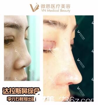 李元石眼鼻真人對(duì)比照