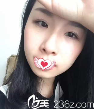 15天雙眼皮恢復的款窄適中 15天雙眼皮恢復的款窄適中