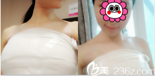 北京美萊假體隆胸案例術(shù)后第4天效果 北京美萊假體隆胸案例術(shù)后第4天效果