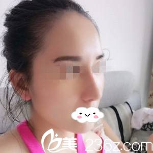 鼻綜合手術(shù)拆線當(dāng)天