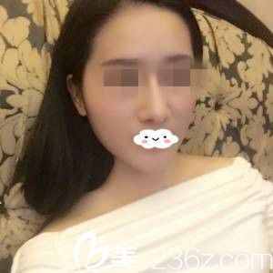 看了衡陽美萊真人案例后，還是選擇了更適合自己的院長(zhǎng)做了膨體隆鼻和縮鼻骨