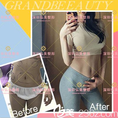 深圳弘美醫(yī)療美容整形醫(yī)院腰腹部吸脂案例圖 深圳弘美醫(yī)療美容整形醫(yī)院腰腹部吸脂案例圖