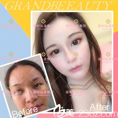 深圳弘美醫(yī)療美容整形醫(yī)院鼻綜合隆鼻案例效果圖 深圳弘美醫(yī)療美容整形醫(yī)院鼻綜合隆鼻案例效果圖
