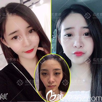 深圳弘美醫(yī)療美容整形醫(yī)院自體脂肪全臉填充案例 深圳弘美醫(yī)療美容整形醫(yī)院自體脂肪全臉填充案例