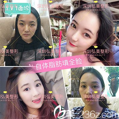 深圳弘美醫(yī)療美容整形醫(yī)院陳國兵自體脂肪全臉填充案例 深圳弘美醫(yī)療美容整形醫(yī)院陳國兵自體脂肪全臉填充案例