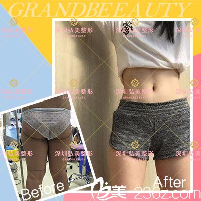 深圳弘美醫(yī)療美容整形醫(yī)院陳國兵腰腹部吸脂案例圖 深圳弘美醫(yī)療美容整形醫(yī)院陳國兵腰腹部吸脂案例圖