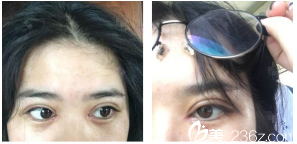 深圳弘美醫(yī)療美容整形醫(yī)院陳國兵院長雙眼皮術(shù)后天圖片 深圳弘美醫(yī)療美容整形醫(yī)院陳國兵院長雙眼皮術(shù)后天圖片