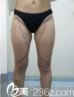 術(shù)前我的大腿 術(shù)前我的大腿