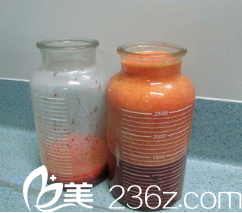 抽出來的脂肪挺惡心的 抽出來的脂肪挺惡心的