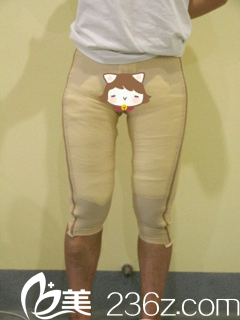 張寶譽醫(yī)生給我做完手術(shù)當天 張寶譽醫(yī)生給我做完手術(shù)當天