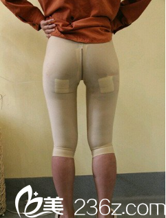 張寶譽大腿吸脂術(shù)后14天 張寶譽大腿吸脂術(shù)后14天