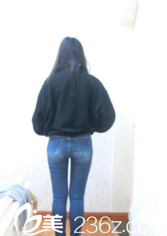 新疆伊麗莎白整形大腿吸脂術(shù)后一個月 新疆伊麗莎白整形大腿吸脂術(shù)后一個月