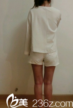 新疆伊麗莎白整形張寶譽把我在健身房練了四個月都沒瘦的大腿吸脂弄瘦了！