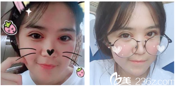 深圳弘美醫(yī)療美容整形醫(yī)院陳國兵院長雙眼皮術(shù)后八天拆線效果圖 深圳弘美醫(yī)療美容整形醫(yī)院陳國兵院長雙眼皮術(shù)后八天拆線效果圖