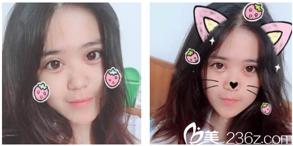 沒想到找深圳弘美醫(yī)療美容整形醫(yī)院陳國兵院長做完雙眼皮變化竟然這么大