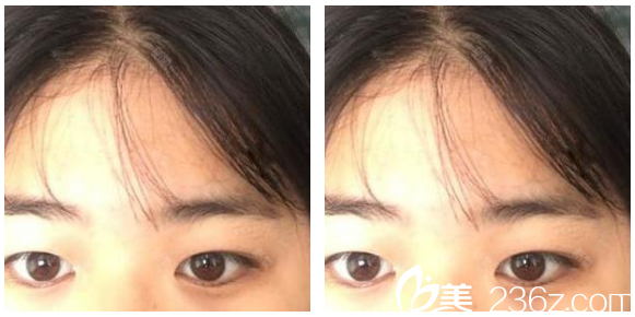 去深圳弘美醫(yī)療美容整形醫(yī)院做雙眼皮前的照片 去深圳弘美醫(yī)療美容整形醫(yī)院做雙眼皮前的照片