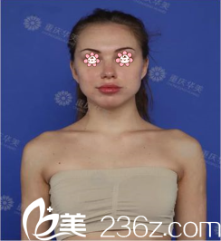 我的術前照 我的術前照