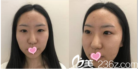 在北京美萊做眼修復鼻綜合之前照 在北京美萊做眼修復鼻綜合之前照