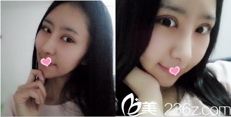 北京美萊<!--<i data=20240703-sp></i>-->眼修復隆鼻案例 北京美萊<!--<i data=20240703-sp></i>-->眼修復隆鼻案例