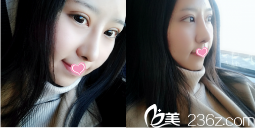 <!--<i data=20240703-sp></i>-->眼修復鼻綜合案例第28天樣子 <!--<i data=20240703-sp></i>-->眼修復鼻綜合案例第28天樣子