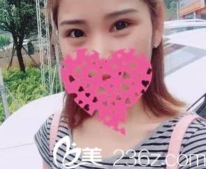 恢復18天的雙眼皮腫脹全消