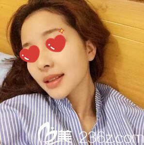 全臉脂肪填充1個月 全臉脂肪填充1個月