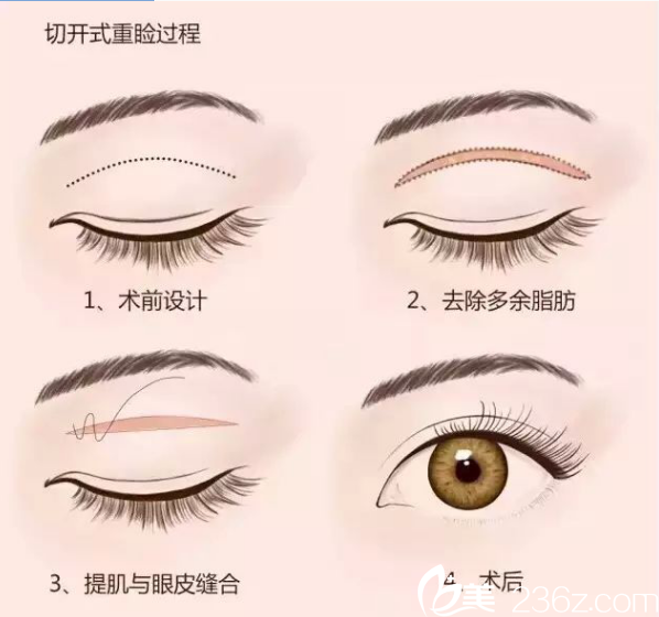 切開(kāi)式重臉過(guò)程