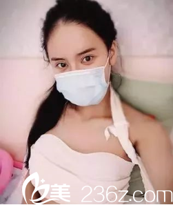 梁潔假體豐胸術(shù)后6天