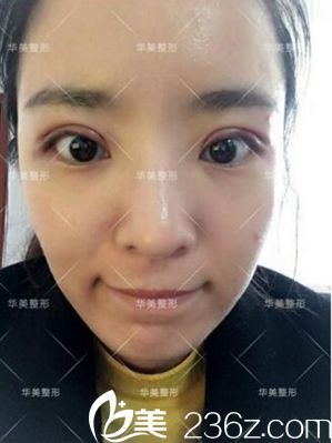 洛陽華美做雙眼皮術后1天 洛陽華美做雙眼皮術后1天