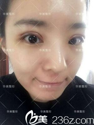 洛陽華美做雙眼皮術后2天 洛陽華美做雙眼皮術后2天