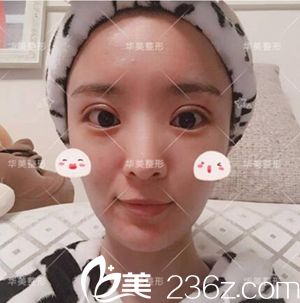 洛陽華美做雙眼皮術后4天 洛陽華美做雙眼皮術后4天
