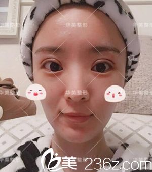 洛陽華美做雙眼皮術后10天 洛陽華美做雙眼皮術后10天