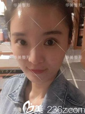 洛陽華美做雙眼皮術后28天 洛陽華美做雙眼皮術后28天